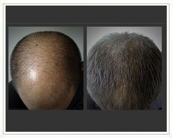 Slider image (6) Giovanni Bojanini | Alopecia Hair Loss Center